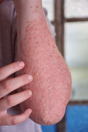 Forearm view of woman with Psoriasisの写真素材