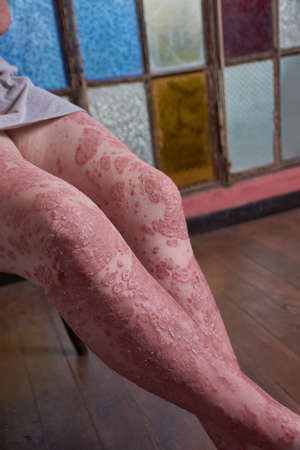 View of thigh knee and leg of woman with Psoriasisの写真素材