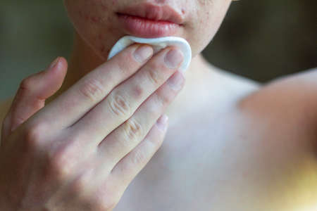 The teenager presses a cotton pad with cleansing lotion on her face. The fight against acneの写真素材