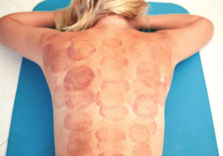 young woman lies on a carpet with traces of vacuum massage. Alternative medicine.の写真素材