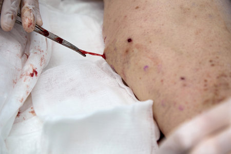 With medical forceps with scissors, the doctor gently pulls the affected vein out of a small hole in...