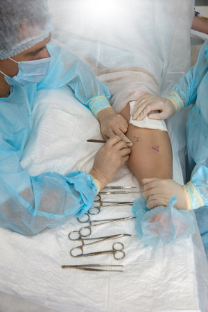 Vascular surgeon prepared to make an incision in marked veins for surgery to remove varicose veins....