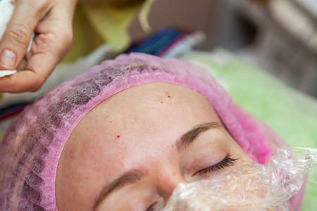 The upper part of the face or forehead of the girl during cosmetic procedures and cleansing the face...