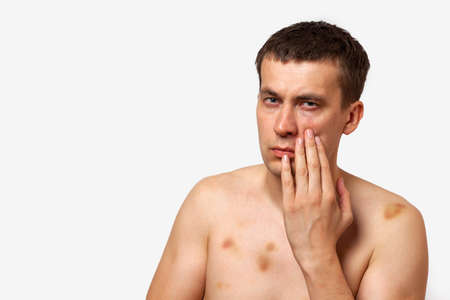 Brunette man with bruises on his body holds his hand to his head in pain after a fight on a white isolated backgroundの写真素材