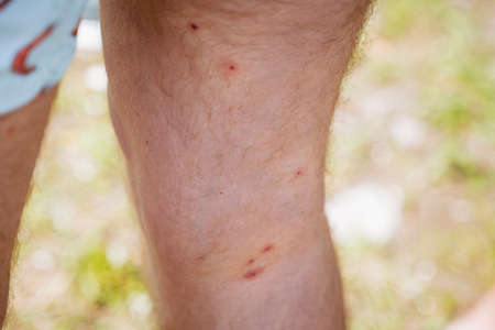 The leg in red dots insect bites, reddening of the skin after midges, mosquito bite irritation, spot itches.の写真素材