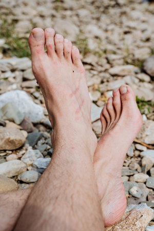 Scratch on the skin, traces of damage to the human skin, burn strips on the leg, redness of the skin...