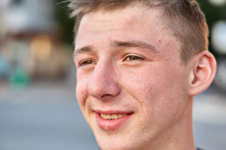 A young happy guy with problem skin having fun while walking around the summer city.