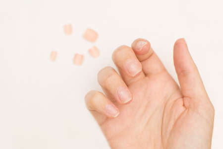 Close up woman nails after bad manicure on light background. Overgrown cuticle fingernails and...