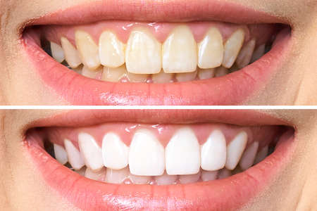 woman teeth before and after whitening. Over white backgroundの写真素材