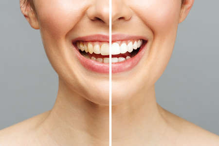 woman teeth before and after whitening. Over white background. Dental clinic patient. Image symbolizes oral care dentistry, stomatology.の写真素材
