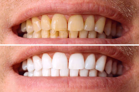 Teeth before and after whitening. Over white background. Dental clinic patient. Image symbolizes...