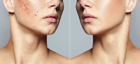 Teenage girl before and after acne treatment Skin care concept. Acne treatment in a cosmetology clinicの写真素材