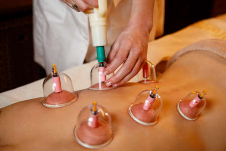 A young woman relaxes in a massage parlor. Vacuum cups of medical cupping therapy on woman back,...