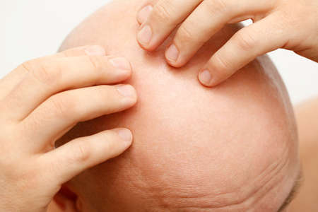 The head of a balding man. A bald man was upset because of the hair loss. Treatment of baldness.