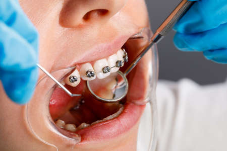 A young woman with metal braces is being examined by an orthodontist. Correction of the bite of teeth in the dental clinic. Concept of healthy teeth.の写真素材