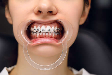 A young woman with metal braces is being examined by an orthodontist. Correction of the bite of teeth in the dental clinic. Concept of healthy teeth.の写真素材