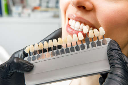 Smiling young woman. Cosmetological teeth whitening in a dental clinic. selection of the tone of the implant toothの写真素材