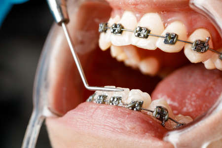 A young woman with metal braces is being examined by an orthodontist. Correction of the bite of...