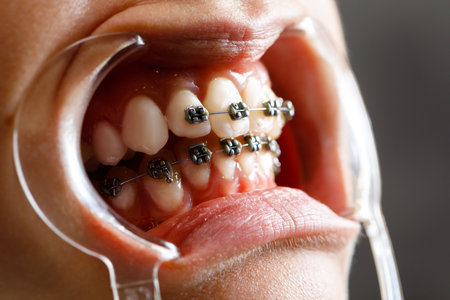 A young woman with metal braces is being examined by an orthodontist. Correction of the bite of teeth in the dental clinic. Concept of healthy teeth.の写真素材