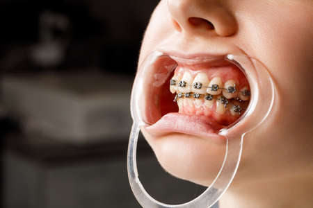 A young woman with metal braces is being examined by an orthodontist. Correction of the bite of...