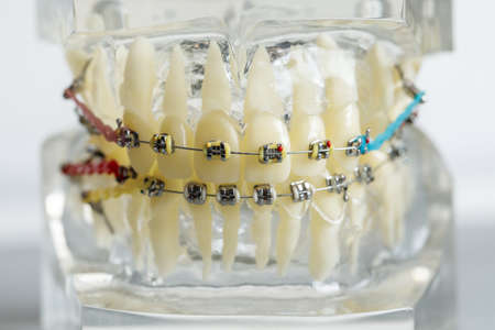 Mould of human teeth close up. dental gypsum model. Plaster cast human jaws prosthetic laboratory....