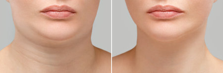 Female double chin before and after correction. Correction of the chin shape liposuction of the...