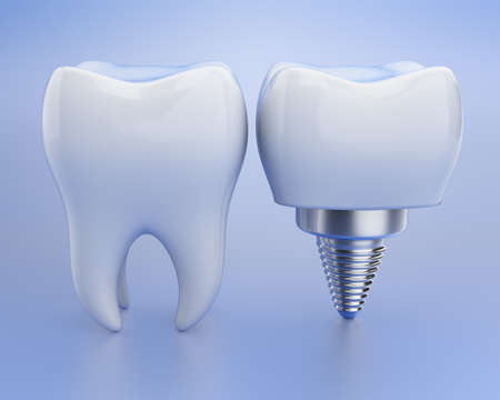 Tooth and dental implant over blue background. 3d render