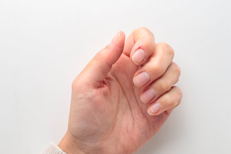 Closeup of deformed nails and torn, ripped and picked on cuticle skin peeling off from human nail...