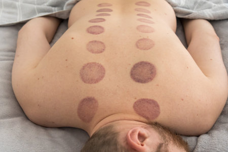 The marks on the man's back are large, deep purple, circular marks caused by cupping therapy, an...