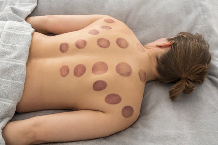 A woman's bare back with numerous large, circular, deep purple bruises after a cupping therapy, a...