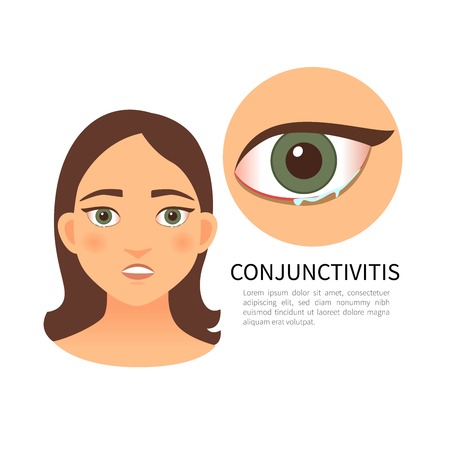 Conjunctivitis. Young girl with conjunctivitis. Pain in the eyes, tearing.
のイラスト素材