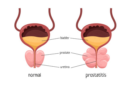 Vector illustration of a healthy prostate and prostatitis. Medical poster.のイラスト素材