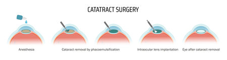 Vectorial medical poster cataract surgery. Stages of lens removal and replacement with a new lens.のイラスト素材