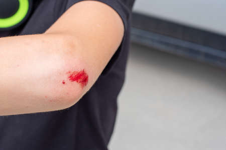 Selective focus of a fresh wound on the arm, elbow with blood. The man injured his hand after...