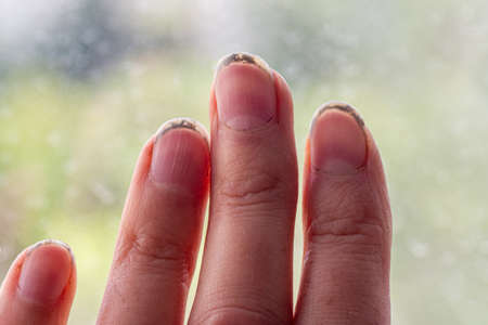 Close-up of a female caucasian hand with dirty brittle nails, broken nails on a natural green...