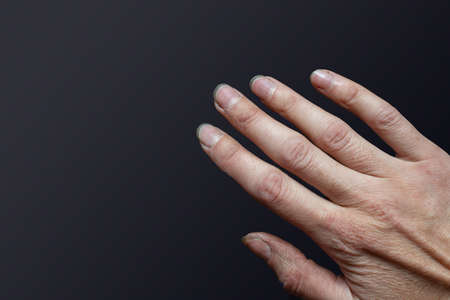 Close-up of female caucasian hand with dirty brittle nails, broken nails on a black background. Peeling on nails. Nail and hand care conceptの写真素材