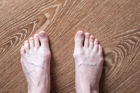 Tired barefoot female legs with protruding veins on a wooden background, top view. Foot health...