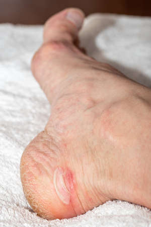 Foot with callus on a white towel, close-up. Red sore on leg from wearing shoes. Bloody callus on...