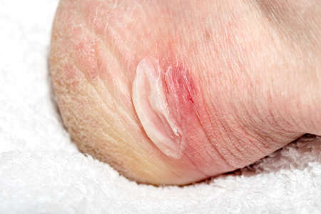 Foot with callus on a white towel, close-up. Red sore on leg from wearing shoes. Bloody callus on the heel. Dry skin on the feet with cracks, peeling of the skin. Foot care concept. Pedicureの写真素材