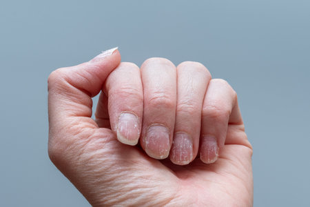 Detailed close-up of a hand showing brittle, dry, and peeling nails, with dehydrated skin on a neutral gray background. Concept of nail health. negative impact of stress. Nail regeneration.の写真素材