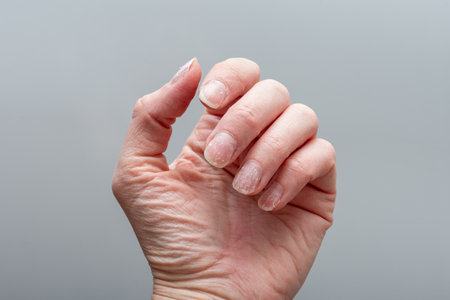 Detailed close-up of a hand showing brittle, dry, and peeling nails, with dehydrated skin. consequences of vitamin and mineral deficiencies. Concept of nail health. negative impact of stress.の写真素材