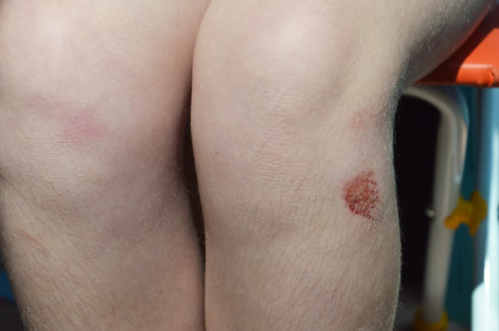 Close-up of a bruise on the skin of the legs