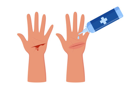 Bleeding cut on the palm, emergency situation. First aid treatment for wound on skin. Trauma, treatment procedure. Vector illustrationのイラスト素材