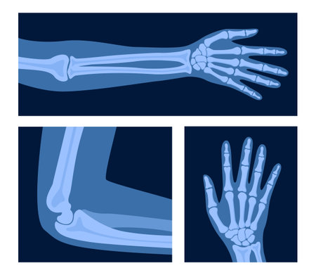 Different x-rays shot of human body part, set. Various x-ray pictures of hand, arm, elbow. Vector illustrationのイラスト素材