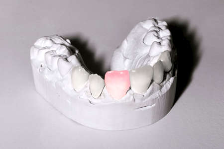 photo of dental gypsum models on the table, concept of sick toothの写真素材