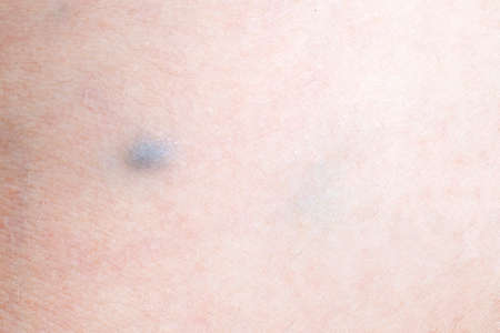 varicose vein disease in a woman, closeup imageの写真素材