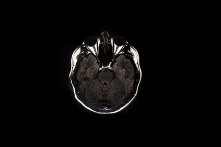 Brain scan, imaging of the brain on x-rayの写真素材