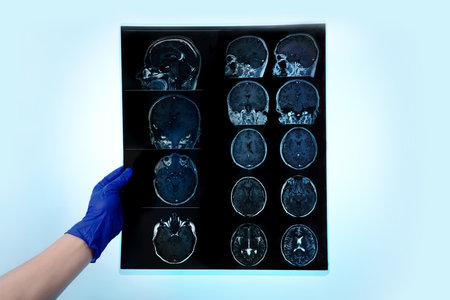 hand in glove holding MRI brain scan or magnetic resonance image results, neurology concept, doctor...