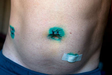 Medical stitches on the body after laparoscopy. Close-up.