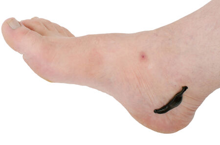 Treatment of foot hirudotherapyの写真素材